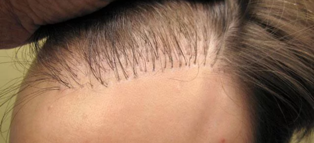 Трихопигментация очаговая алопеция. Трансплантация волос у женщин.