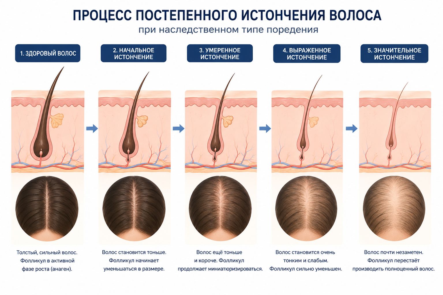 Процесс постепенного истончения волоса при наследственном типе поредения